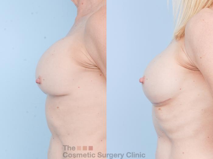 Before & After Breast Revision / Implant Removal Case 893 Left Side View in Waterloo, Ontario