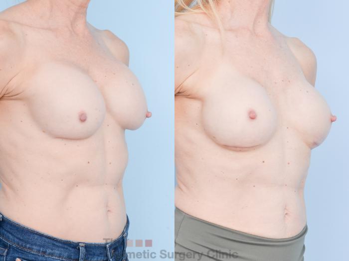 Before & After Breast Revision / Implant Removal Case 893 Right Oblique View in Waterloo, Ontario