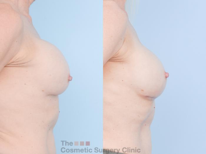 Before & After Breast Revision / Implant Removal Case 893 Right Side View in Waterloo, Ontario