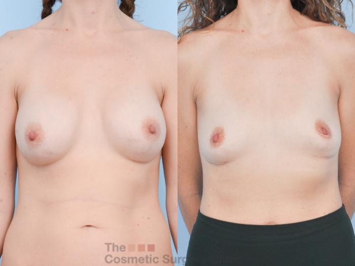 Before & After Breast Revision / Implant Removal Case 895 Front View in Waterloo, Ontario