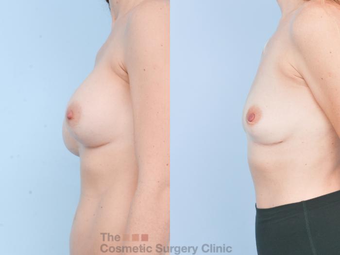 Before & After Breast Revision / Implant Removal Case 895 Left Side View in Waterloo, Ontario
