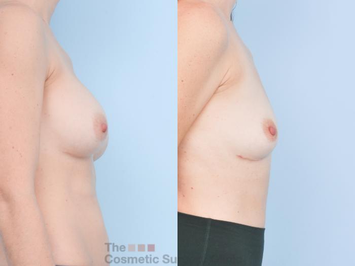 Before & After Breast Revision / Implant Removal Case 895 Right Side View in Waterloo, Ontario