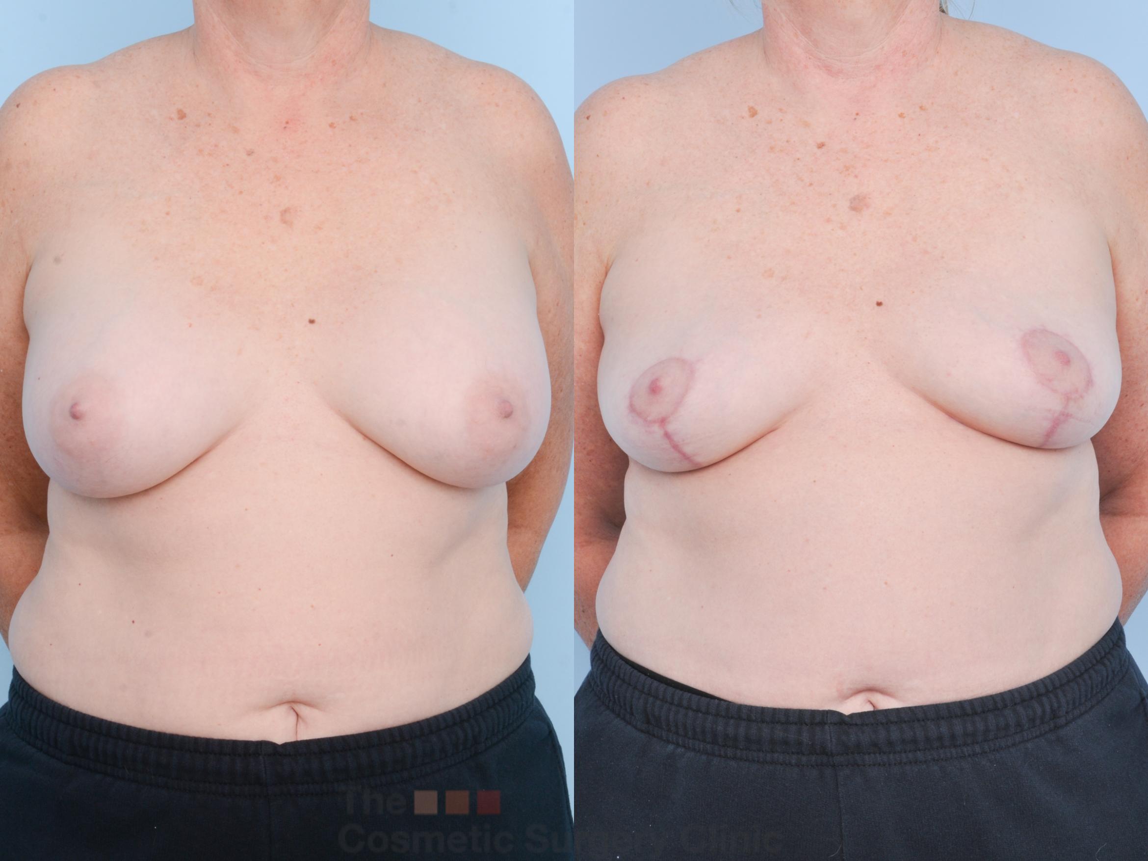Before & After Breast Revision / Implant Removal Case 897 Front View in Waterloo, Ontario