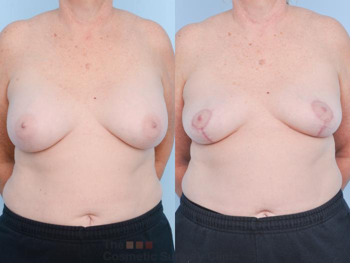 Before & After Breast Revision / Implant Removal Case 897 Front View in Waterloo, Ontario