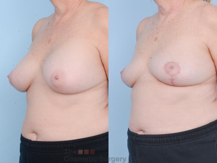 Before & After Breast Revision / Implant Removal Case 897 Left Oblique View in Waterloo, Ontario