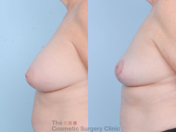 Before & After Breast Revision / Implant Removal Case 897 Left Side View in Waterloo, Ontario