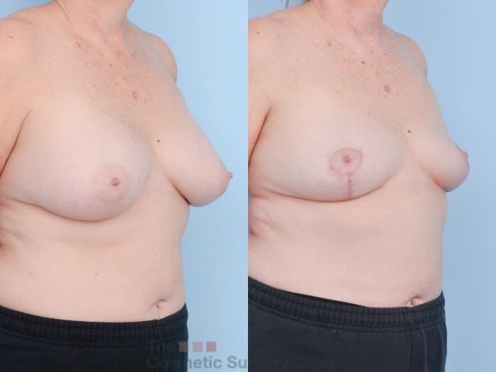 Before & After Breast Revision / Implant Removal Case 897 Right Oblique View in Waterloo, Ontario