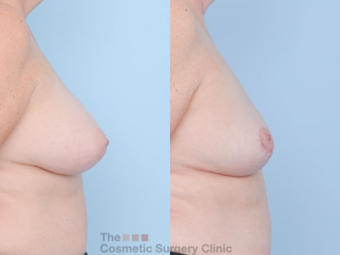 Before & After Breast Revision / Implant Removal Case 897 Right Side View in Waterloo, Ontario