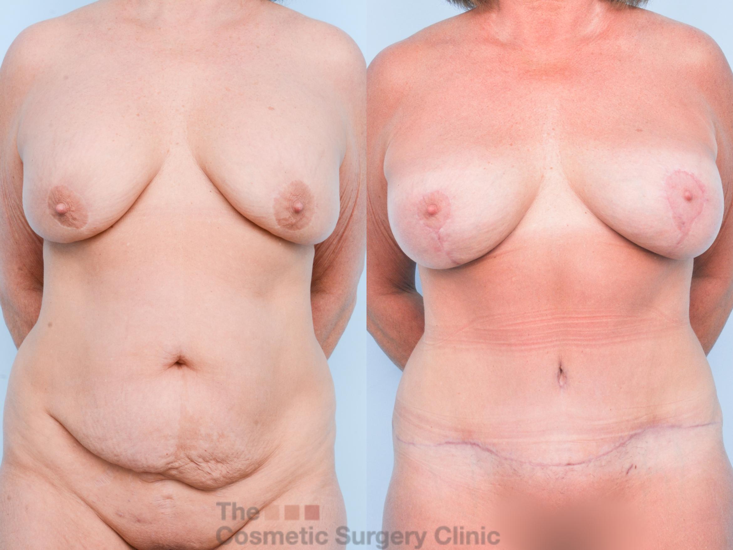 Before & After Breast Revision / Implant Removal Case 902 Front View in Waterloo, Ontario