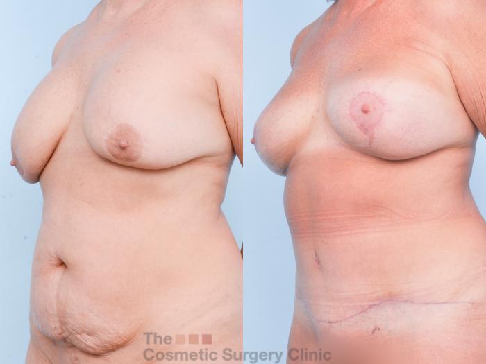Before & After Breast Revision / Implant Removal Case 902 Left Oblique View in Waterloo, Ontario