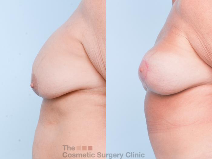 Before & After Breast Revision / Implant Removal Case 902 Left Side View in Waterloo, Ontario