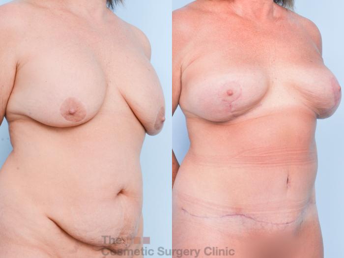 Before & After Breast Revision / Implant Removal Case 902 Right Oblique View in Waterloo, Ontario