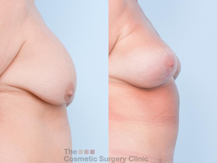 Before & After Breast Revision / Implant Removal Case 902 Right Side View in Waterloo, Ontario
