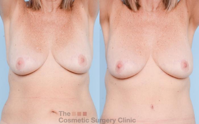 Before & After Chest Lift Case 793 Front View in Waterloo, Ontario