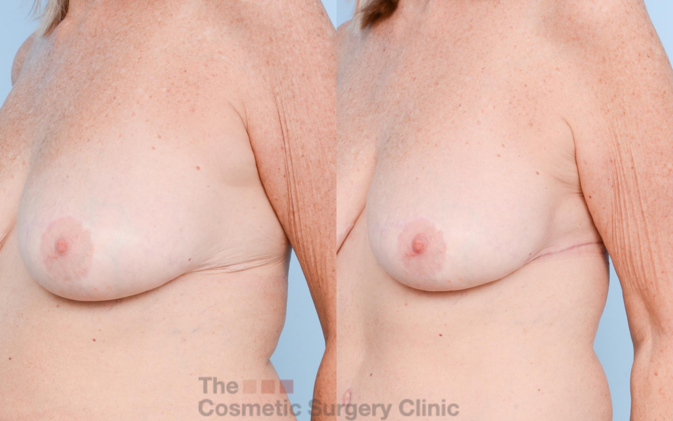 Before & After Chest Lift Case 793 Left Oblique View in Waterloo, Ontario