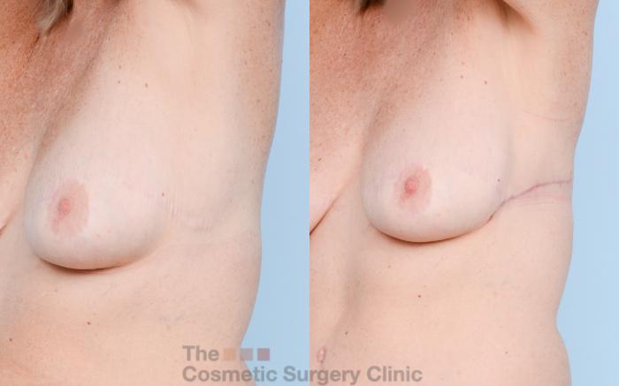 Before & After Chest Lift Case 793 Left Oblique Extended View in Waterloo, Ontario