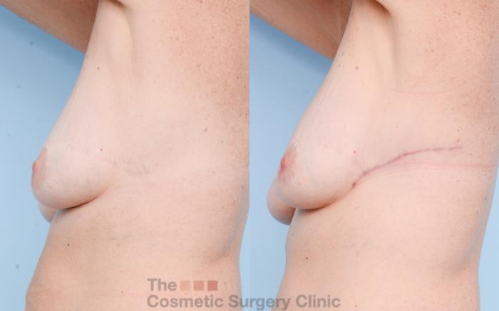 Before & After Chest Lift Case 793 Left Side Extended View in Waterloo, Ontario