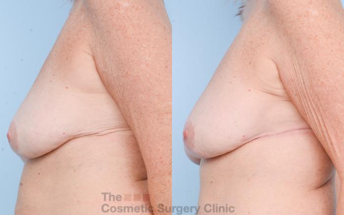 Before & After Chest Lift Case 793 Left Side View in Waterloo, Ontario