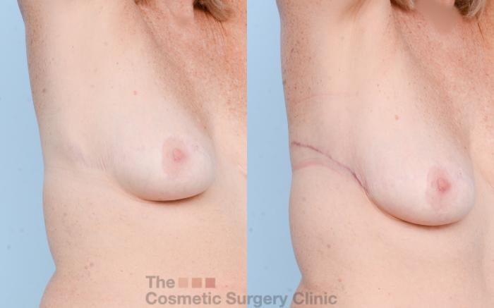 Before & After Chest Lift Case 793 Right Oblique Extended View in Waterloo, Ontario