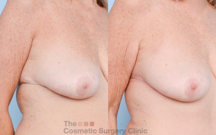 Before & After Chest Lift Case 793 Right Oblique View in Waterloo, Ontario