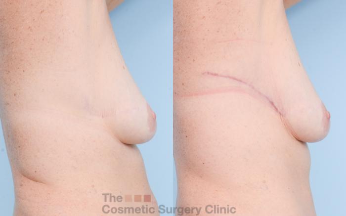 Before & After Chest Lift Case 793 Right Side Extended View in Waterloo, Ontario