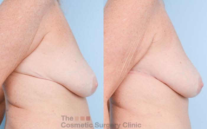 Before & After Chest Lift Case 793 Right Side View in Waterloo, Ontario