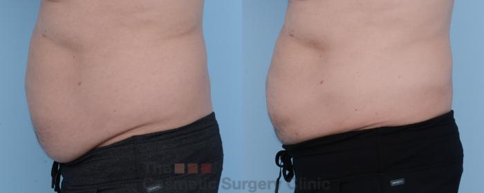 Before & After CoolSculpting Case 305 View #2 View in Waterloo, Ontario