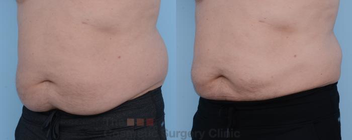 Before & After CoolSculpting Case 305 View #3 View in Waterloo, Ontario