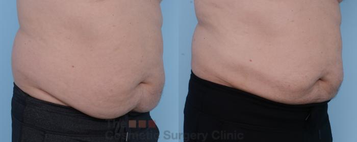 Before & After CoolSculpting Case 305 View #4 View in Waterloo, Ontario