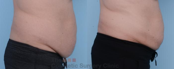 Before & After CoolSculpting Case 305 View #5 View in Waterloo, Ontario