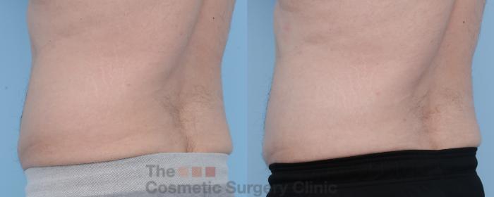Before & After CoolSculpting Case 306 View #2 View in Waterloo, Ontario
