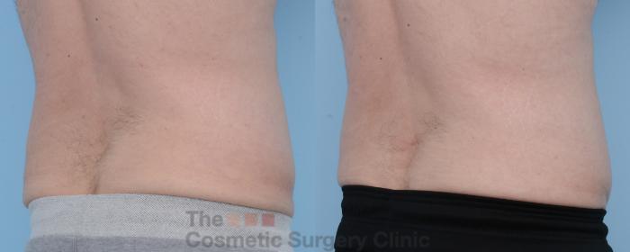 Before & After CoolSculpting Case 306 View #3 View in Waterloo, Ontario