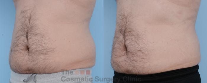 Before & After CoolSculpting Case 306 View #4 View in Waterloo, Ontario