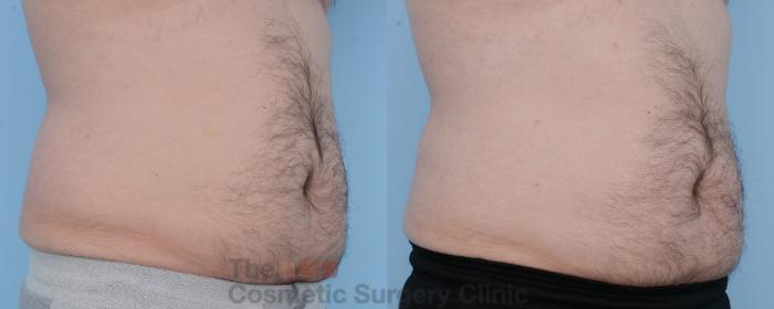 Before & After CoolSculpting Case 306 View #5 View in Waterloo, Ontario