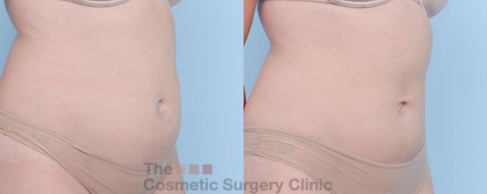 Before & After CoolSculpting Case 403 View #2 View in Waterloo, Ontario