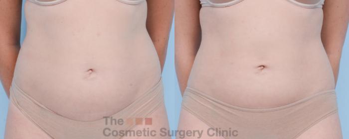 Before & After CoolSculpting Case 403 View #3 View in Waterloo, Ontario