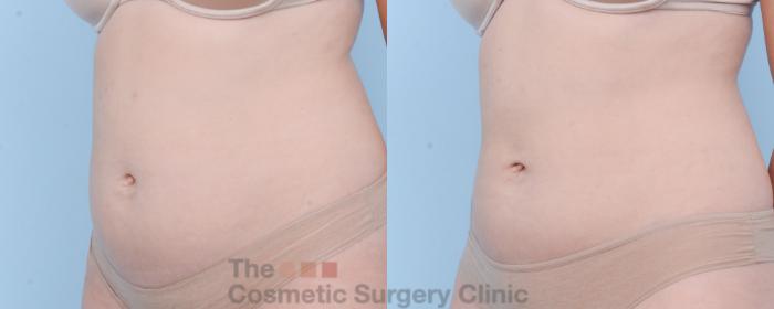 Before & After CoolSculpting Case 403 View #4 View in Waterloo, Ontario