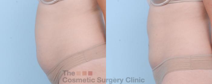 Before & After CoolSculpting Case 403 View #5 View in Waterloo, Ontario