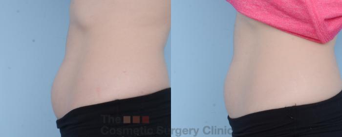 Before & After CoolSculpting Case 471 View #2 View in Waterloo, Ontario