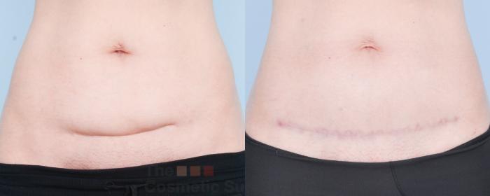 Before & After C-Section Scar Revision Case 885 Front View in Waterloo, Ontario