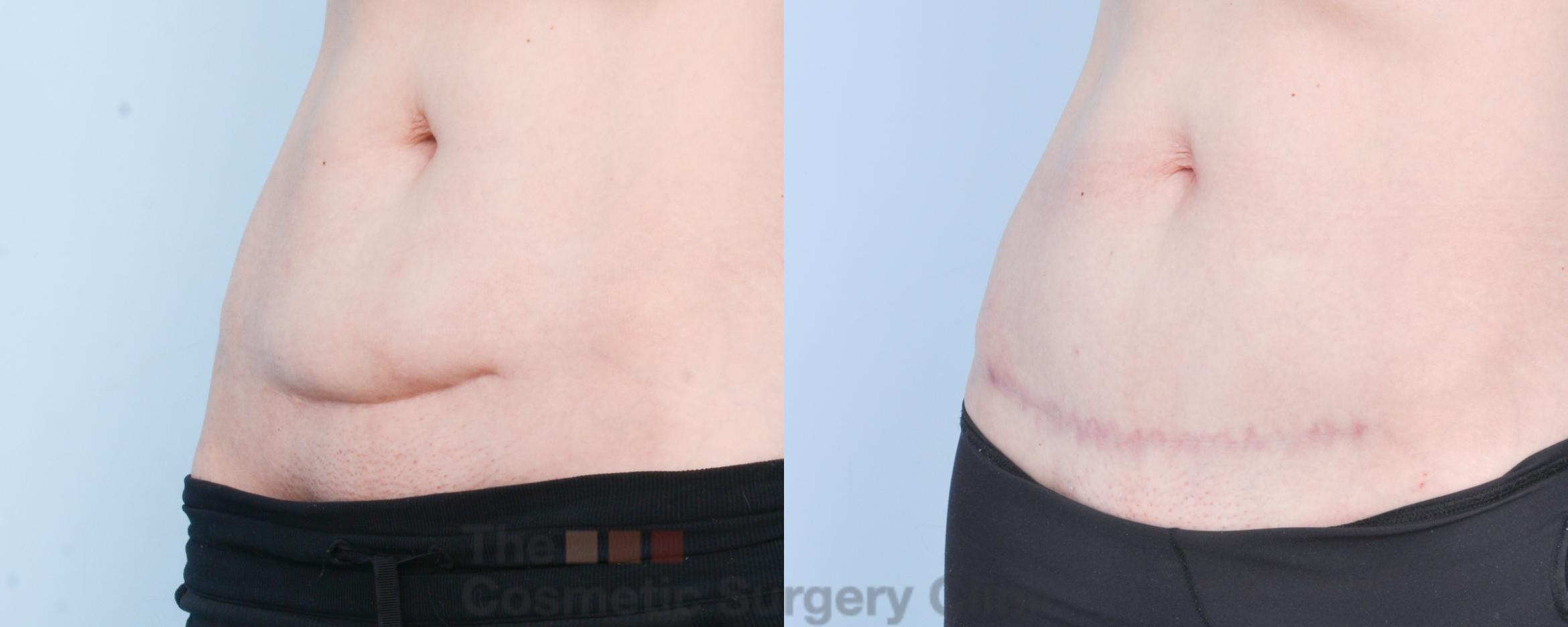 C-Section Scar Revision Before and After Pictures Case 885 | Waterloo
