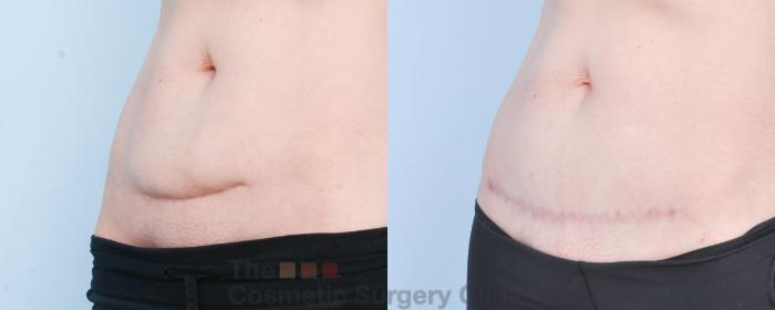Before & After C-Section Scar Revision Case 885 Left Oblique View in Waterloo, Ontario