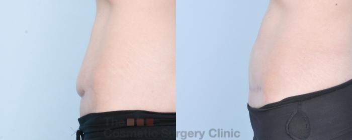 Before & After C-Section Scar Revision Case 885 Left Side View in Waterloo, Ontario