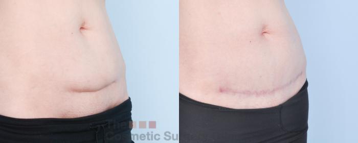 Before & After C-Section Scar Revision Case 885 Right Oblique View in Waterloo, Ontario