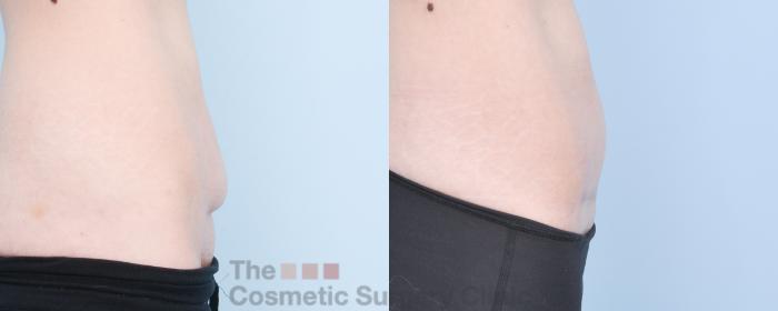 Before & After C-Section Scar Revision Case 885 Right Side View in Waterloo, Ontario