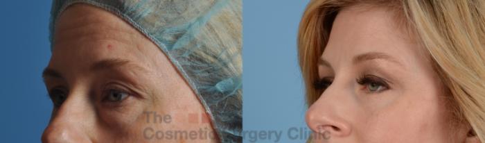 Before & After Eyelid Lift Case 119 View #2 View in Waterloo, Ontario