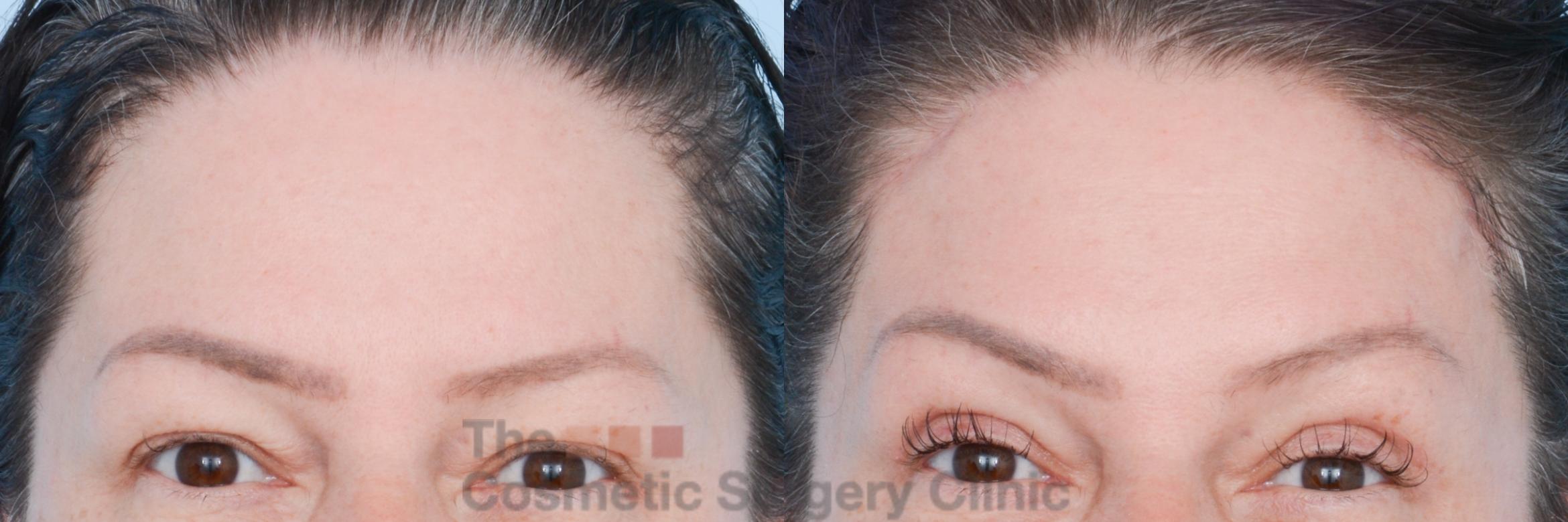 Before & After Brow Lift Case 829 Front View in Waterloo, Ontario