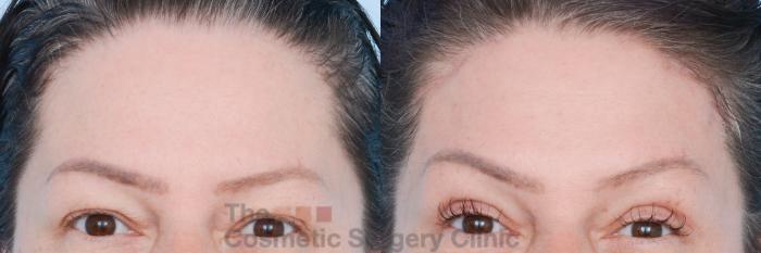 Before & After Brow Lift Case 829 Front View in Waterloo, Ontario