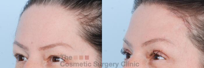 Before & After Brow Lift Case 829 Left Oblique View in Waterloo, Ontario