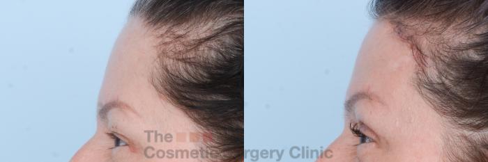 Before & After Brow Lift Case 829 Left Side View in Waterloo, Ontario